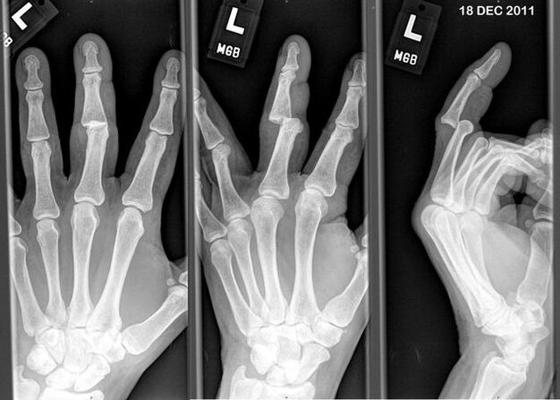 Röntgenaufnahme von dislozierten Fingern