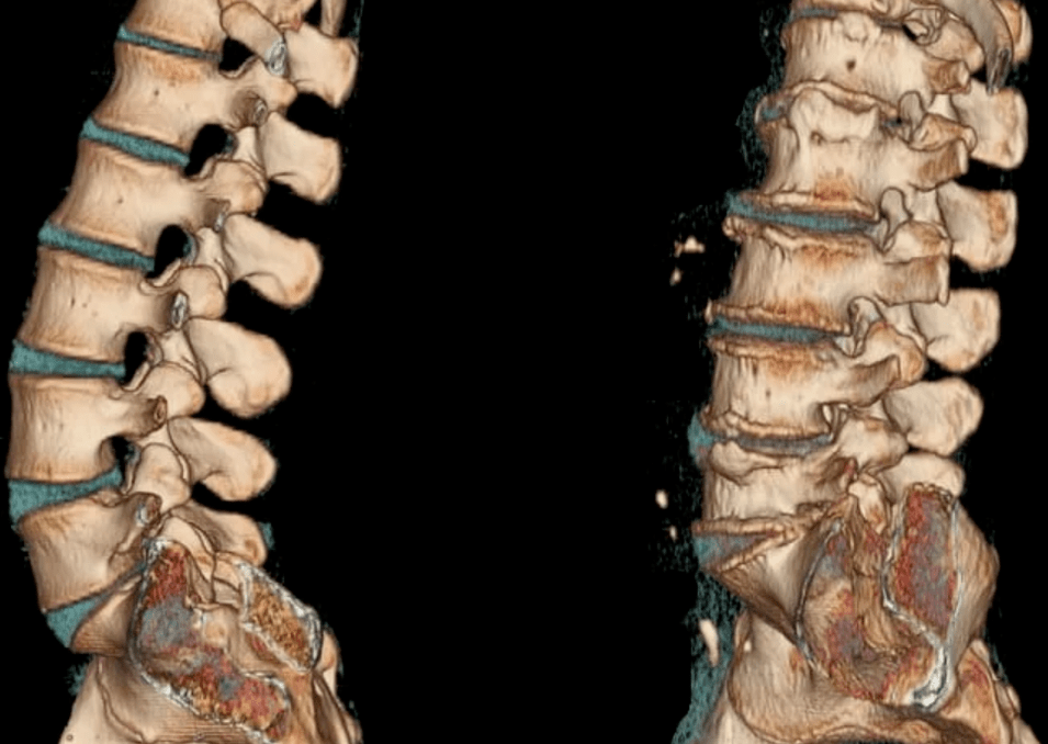 Osteochondrose