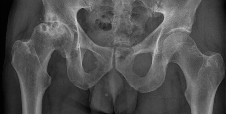 Deformierende Arthrose des Hüftgelenks im Röntgenbild