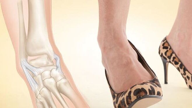 die Verwendung von Schuhen mit Absätzen als Ursache für Arthrose im Sprunggelenk