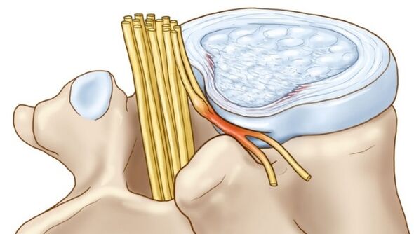 Eine lumbale Osteochondrose kann zu Komplikationen in Form eines Zwischenwirbelbruchs führen. 