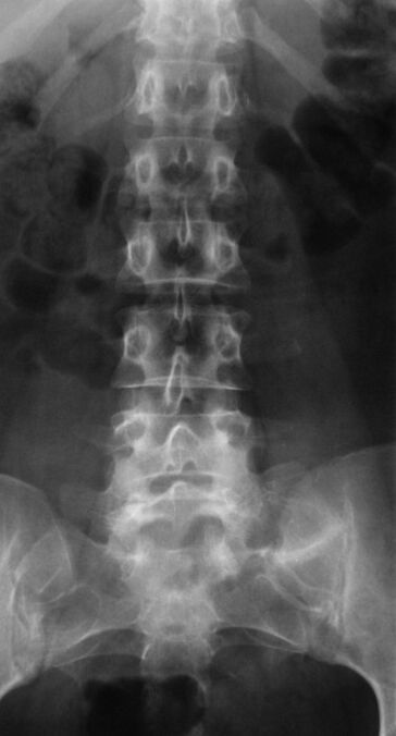 Zur Diagnose einer lumbalen Osteochondrose wird eine Röntgenaufnahme durchgeführt. 