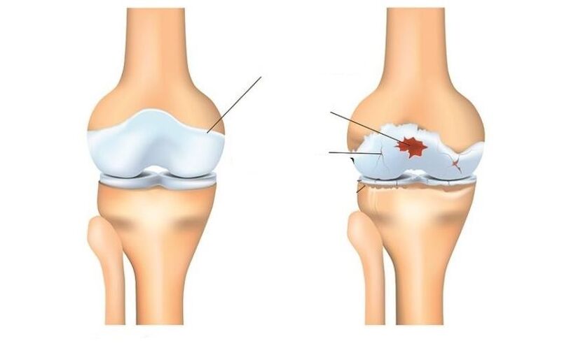 Gesund und geduldig mit Arthrosis Artikulationen