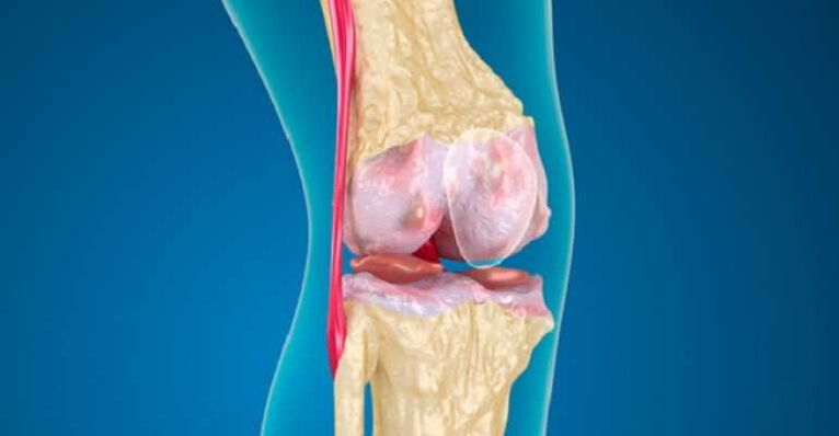 Osteoarthritis der Kniegelenkkrankheit, die die Zerstörung des Knorpels in den Gelenken verursacht