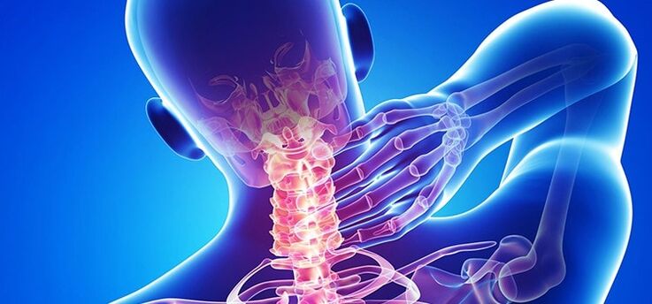 Osteochondrose der Halswirbelsäule